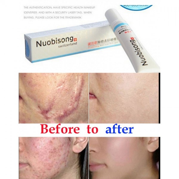 Nuobisong Face Care Acne Scar Removal Cream Fast Effect Original Buyon Pk